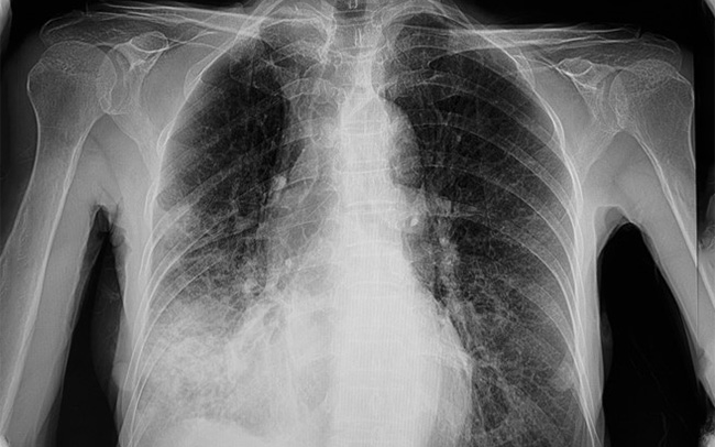 Postkovid pregled pulmologa + RTG pluća