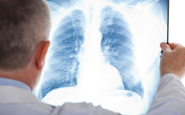 Pregled pulmologa + RTG pluća